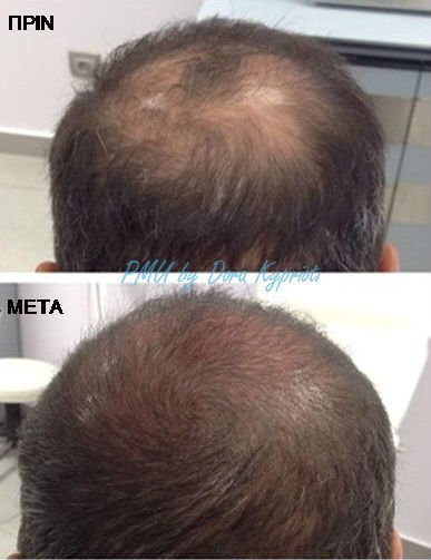 ΔΩΡΑ ΚΥΠΡΙΩΤΗ - Ιατρικό Μόνιμο Μακιγιάζ