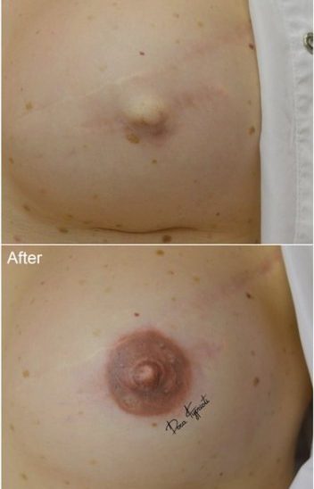 ΔΩΡΑ ΚΥΠΡΙΩΤΗ - Ιατρικό Μόνιμο Μακιγιάζ