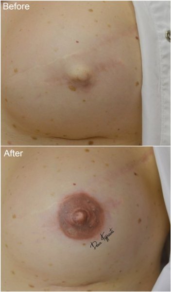 ΔΩΡΑ ΚΥΠΡΙΩΤΗ - Ιατρικό Μόνιμο Μακιγιάζ