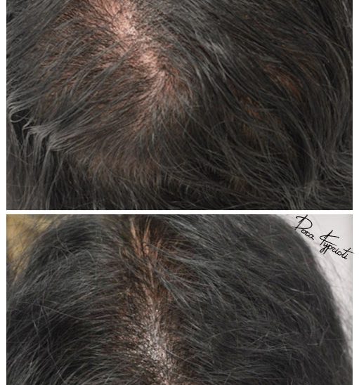 ΔΩΡΑ ΚΥΠΡΙΩΤΗ - Ιατρικό Μόνιμο Μακιγιάζ