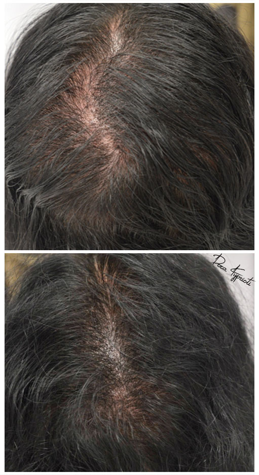 ΔΩΡΑ ΚΥΠΡΙΩΤΗ - Ιατρικό Μόνιμο Μακιγιάζ