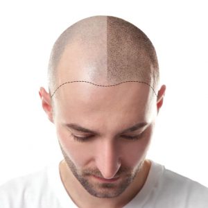 scalp-micropigmentation